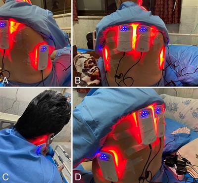 Photobiomodulation Improves Serum Cytokine Response in Mild to Moderate COVID-19: The First Randomized, Double-Blind, Placebo Controlled, Pilot Study
